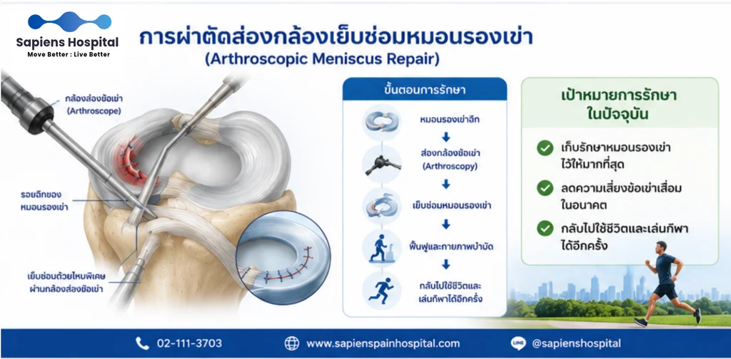 หมอนรองเข่าฉีก
