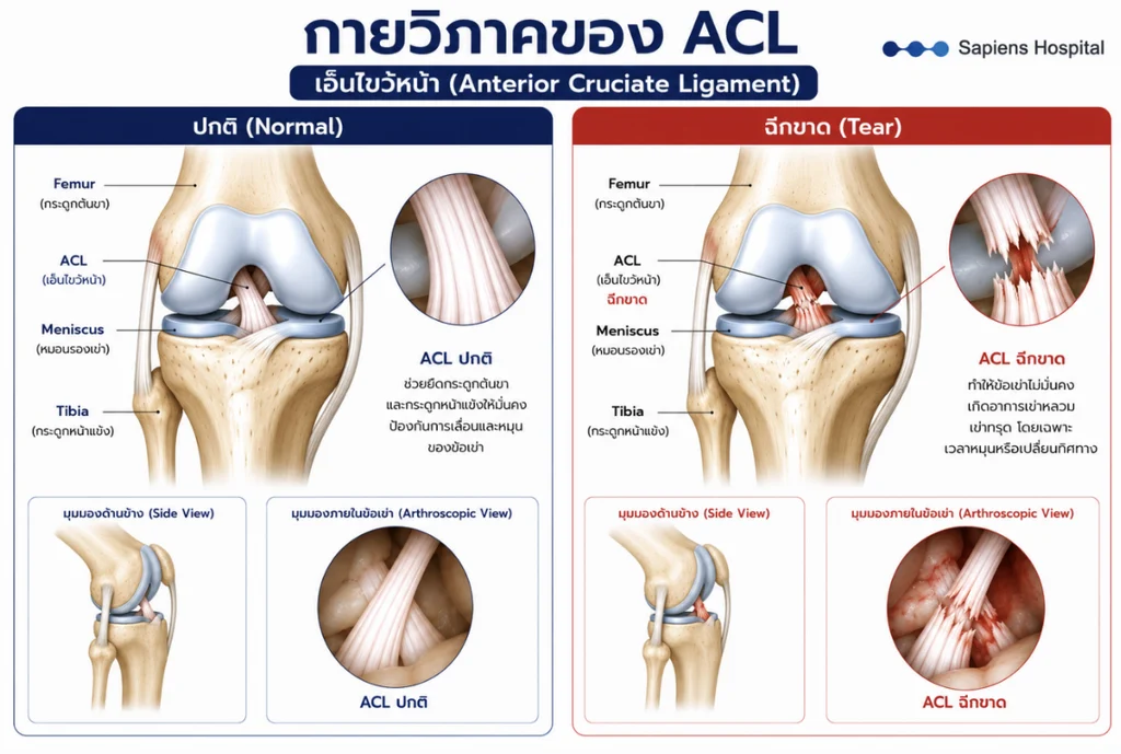 เอ็นไขว้หน้า ACL 