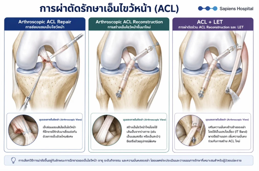 เอ็นไขว้หน้า ACL ผ่าตัด